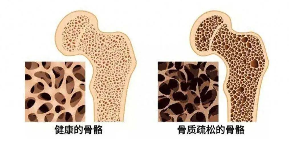還在“盲目”防曬?小心骨頭“偷偷”變脆 還在“盲目”防曬?小心骨頭“偷偷”變脆